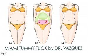 An example of the Miami tummy tuck procedure by Dr. Bernabe Vazquez