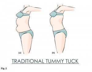 An example of the traditional tummy tuck results