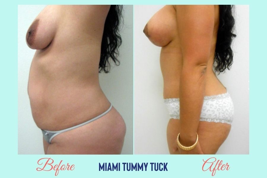Tummy Tuck Miami - Voted Best Abdominoplasty Surgeon Miami
