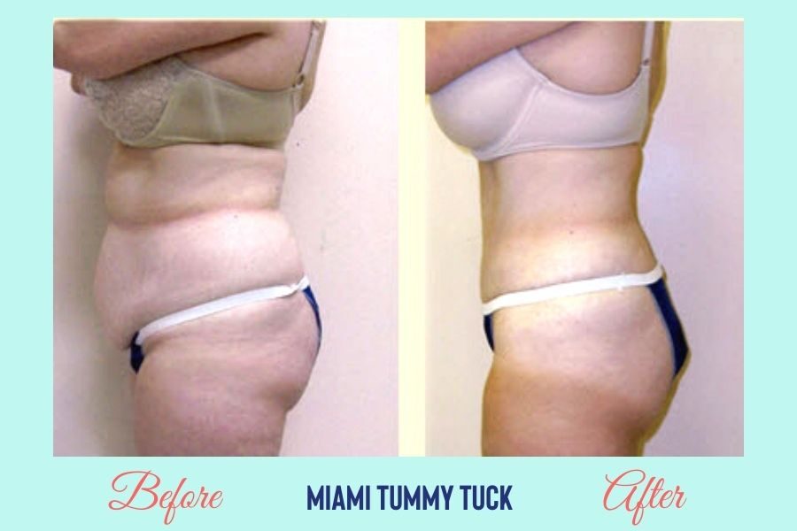 Tummy Tuck Surgery Miami - Abdominoplasty