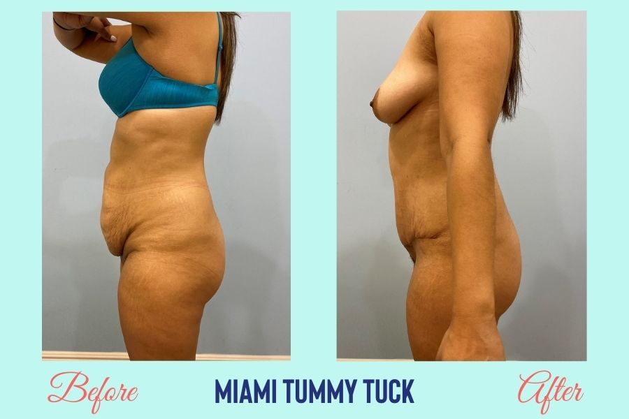 Tummy Tuck Surgery Miami - Abdominoplasty