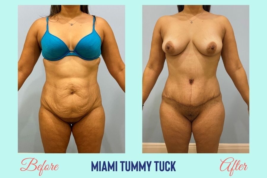 Tummy Tuck Surgery Miami - Abdominoplasty | Dr. Bernabe Vazquez