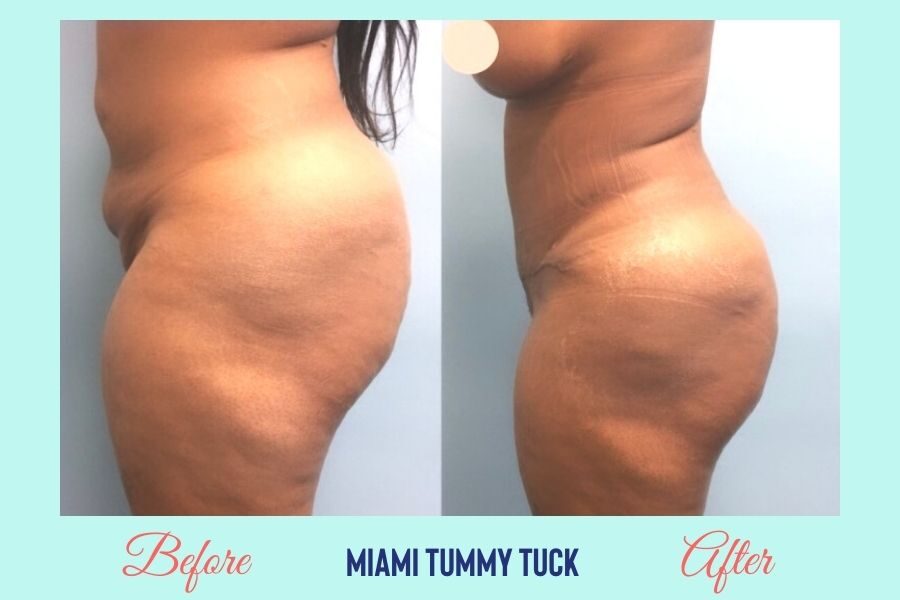 Tummy Tuck Miami - $3800 Abdominoplasty