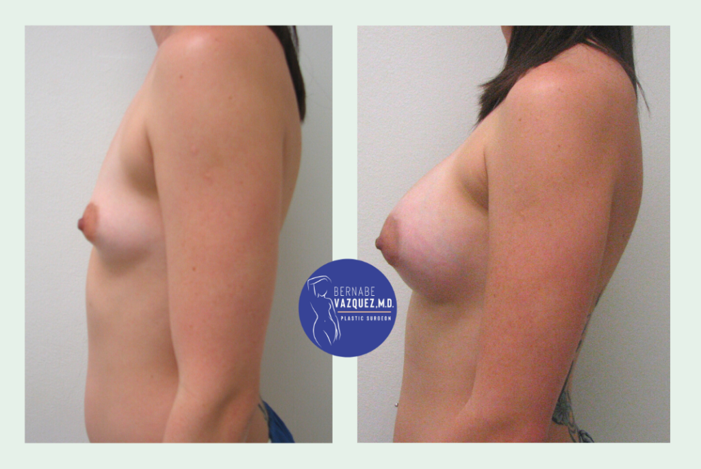 Breast augmentation surgery results